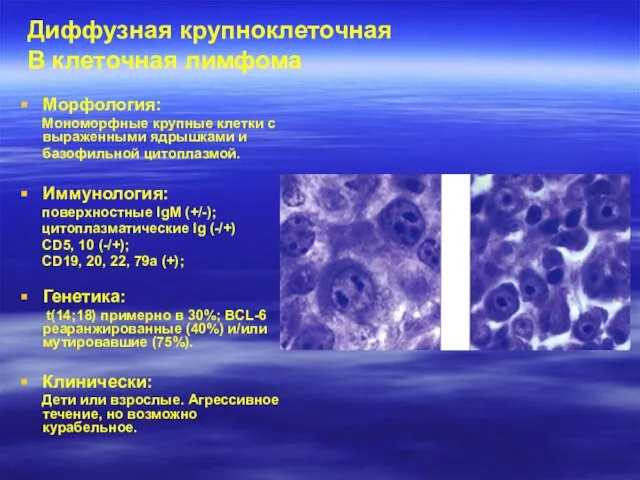 Диффузная крупноклеточная В клеточная лимфома Морфология: Мономорфные крупные клетки с выраженными