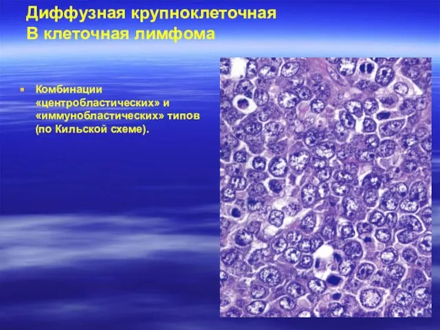 Диффузная крупноклеточная В клеточная лимфома Комбинации «центробластических» и «иммунобластических» типов (по Кильской схеме).