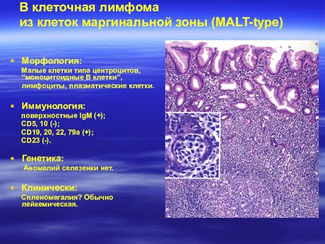 В клеточная лимфома из клеток маргинальной зоны (MALT-type) Морфология: Малые клетки