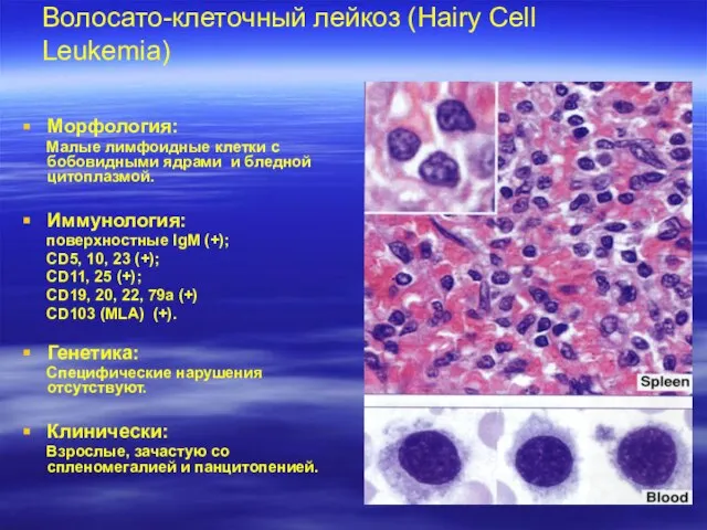 Волосато-клеточный лейкоз (Hairy Cell Leukemia) Морфология: Малые лимфоидные клетки с бобовидными