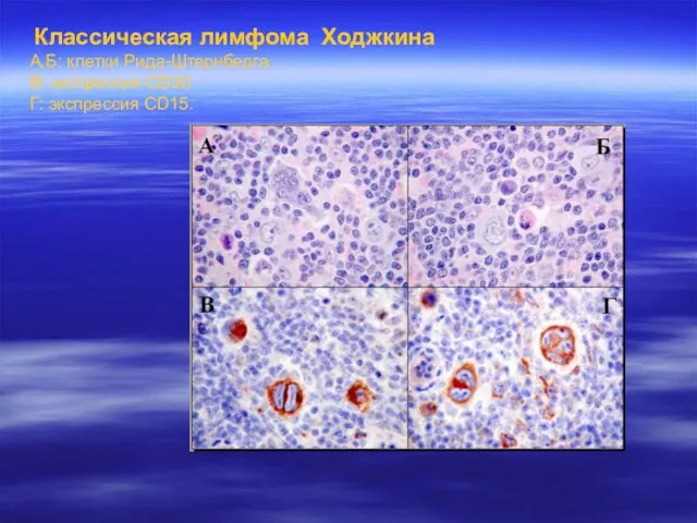 Классическая лимфома Ходжкина А,Б: клетки Рида-Штернберга. В: экспрессия CD30 Г: экспрессия CD15.