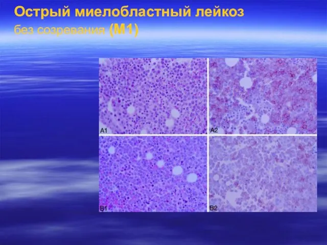 Острый миелобластный лейкоз без созревания (М1)