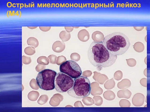 Острый миеломоноцитарный лейкоз (M4)