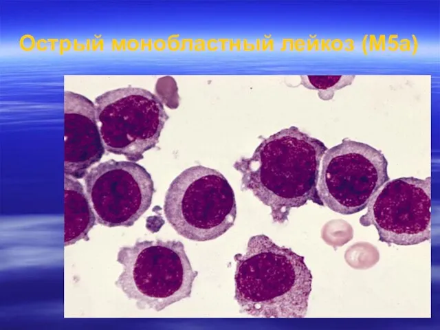 Острый монобластный лейкоз (M5a)