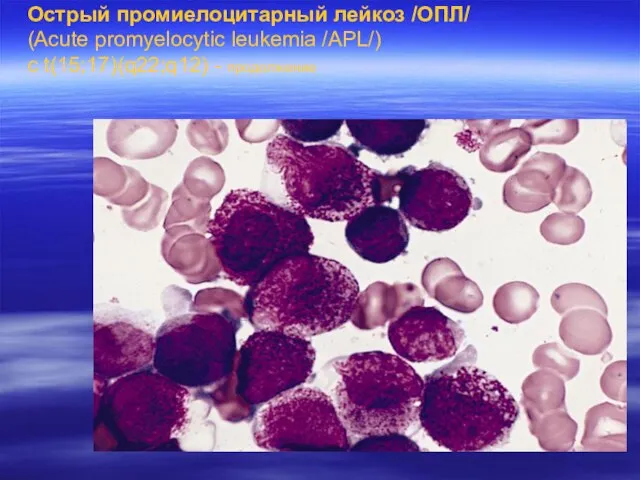 Острый промиелоцитарный лейкоз /ОПЛ/ (Acute promyelocytic leukemia /APL/) с t(15;17)(q22;q12) - продолжение