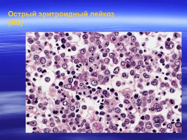 Острый эритроидный лейкоз (M6)