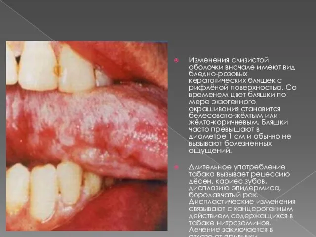 Изменения слизистой оболочки вначале имеют вид бледно-розовых кератотических бляшек с рифлёной