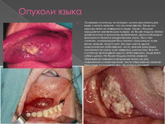 Опухоли языка Основные симптомы, по которым можно распознать рак языка и