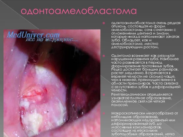 одонтоамелобластома одонтоамелобластома очень редкая опухоль, состоящая из форм амелобластомы, сочв сочетании