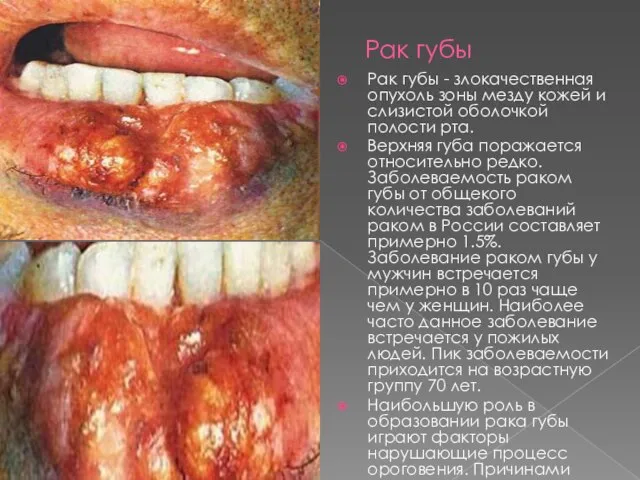 Рак губы Рак губы - злокачественная опухоль зоны мезду кожей и