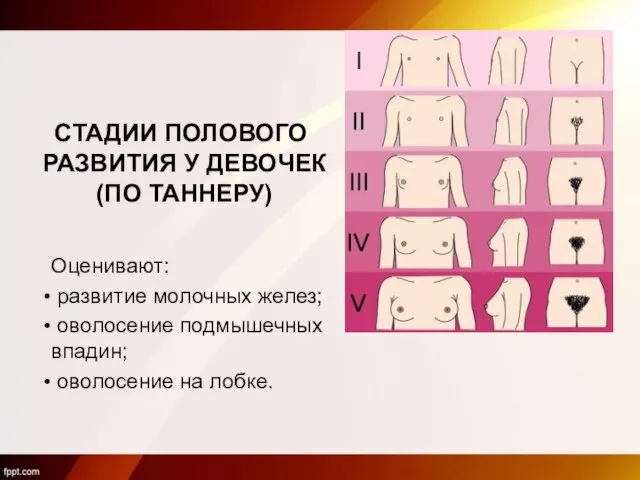 СТАДИИ ПОЛОВОГО РАЗВИТИЯ У ДЕВОЧЕК (ПО ТАННЕРУ) Оценивают: развитие молочных желез;