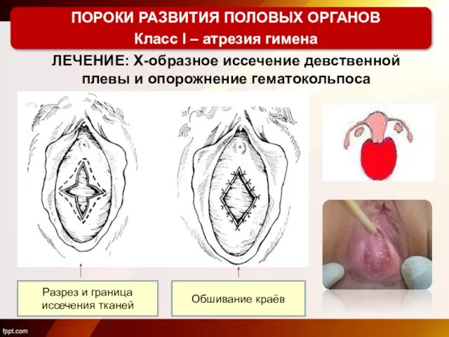 ПОРОКИ РАЗВИТИЯ ПОЛОВЫХ ОРГАНОВ Класс I – атрезия гимена ЛЕЧЕНИЕ: Х-образное