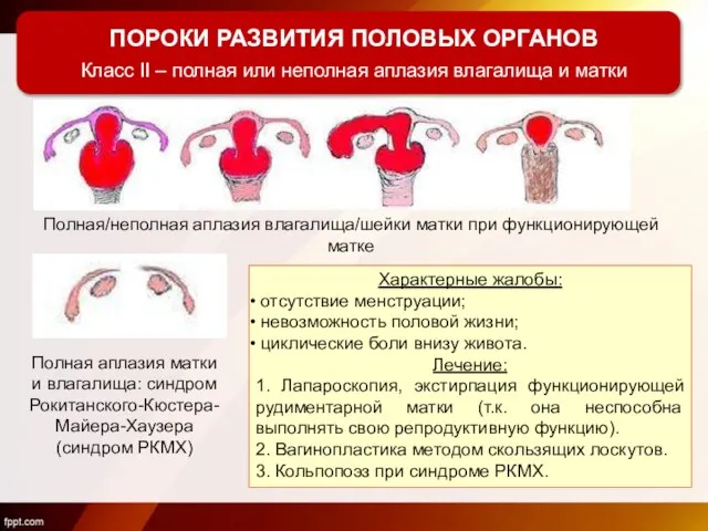 ПОРОКИ РАЗВИТИЯ ПОЛОВЫХ ОРГАНОВ Класс II – полная или неполная аплазия