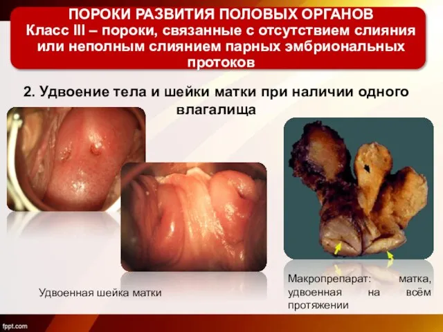 2. Удвоение тела и шейки матки при наличии одного влагалища ПОРОКИ