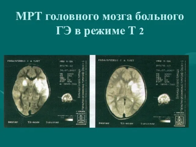 МРТ головного мозга больного ГЭ в режиме Т 2