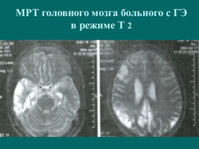 МРТ головного мозга больного с ГЭ в режиме Т 2