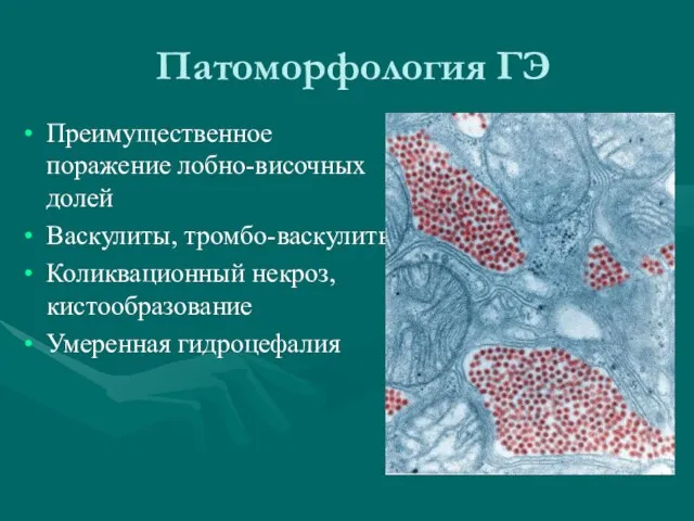 Патоморфология ГЭ Преимущественное поражение лобно-височных долей Васкулиты, тромбо-васкулиты Коликвационный некроз, кистообразование Умеренная гидроцефалия