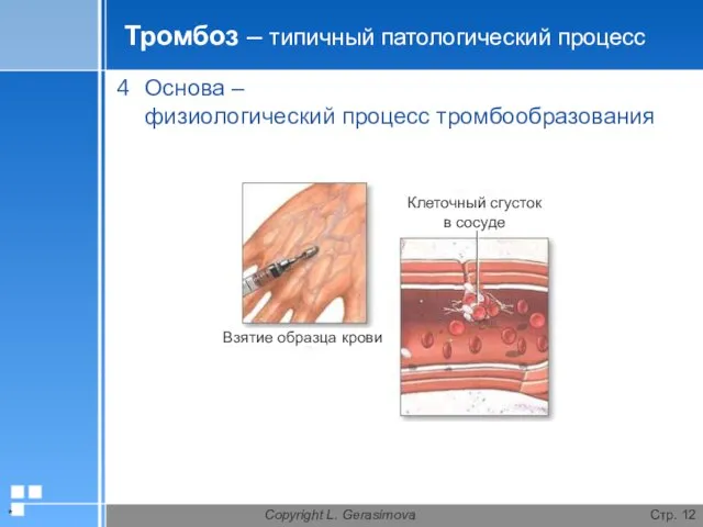 * Copyright L. Gerasimova Стр. Тромбоз – типичный патологический процесс Основа – физиологический процесс тромбообразования