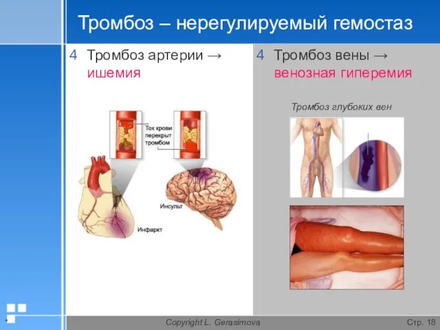 * Copyright L. Gerasimova Стр. Тромбоз – нерегулируемый гемостаз Тромбоз артерии
