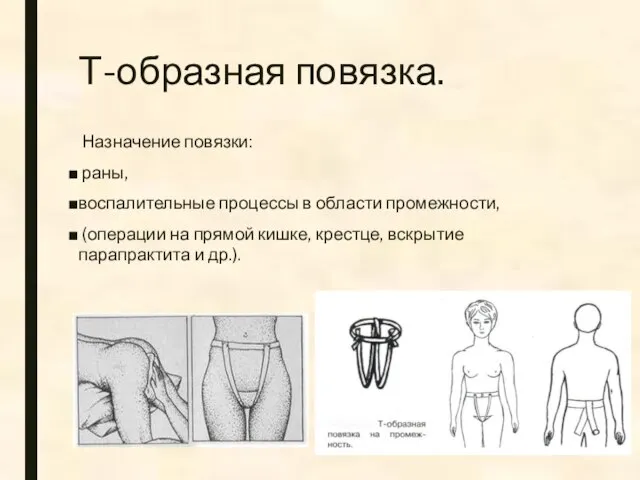 Т-образная повязка. Назначение повязки: раны, воспалительные процессы в области промежности, (операции