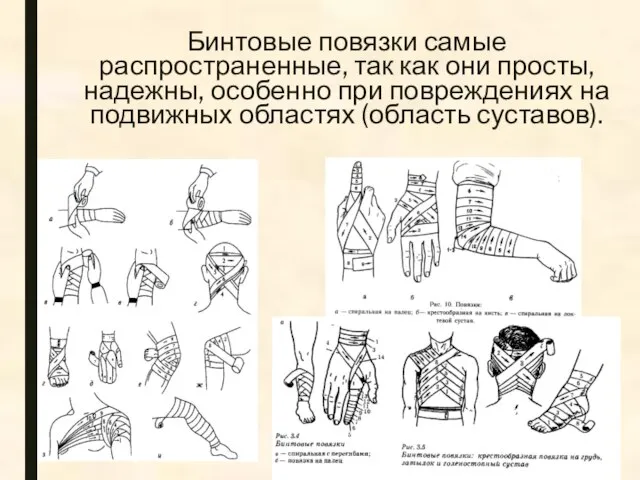 Бинтовые повязки самые распространенные, так как они просты, надежны, особенно при