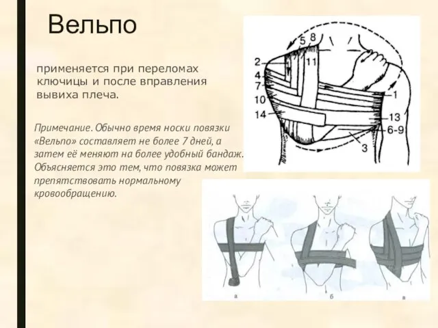 Вельпо применяется при переломах ключицы и после вправления вывиха плеча. Примечание.