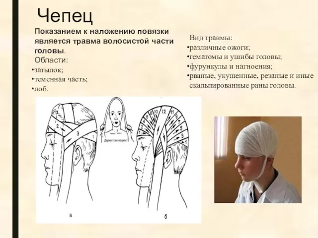 Чепец Вид травмы: различные ожоги; гематомы и ушибы головы; фурункулы и