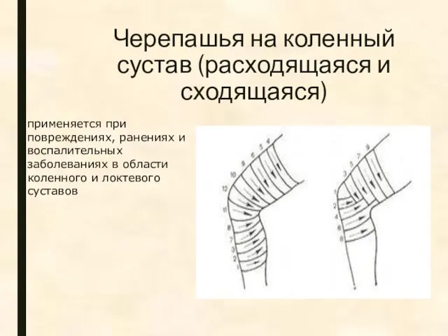 Черепашья на коленный сустав (расходящаяся и сходящаяся) применяется при повреждениях, ранениях