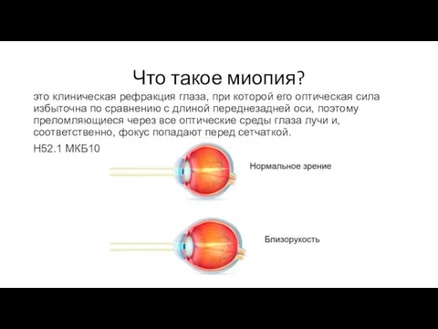 Что такое миопия? это клиническая рефракция глаза, при которой его оптическая