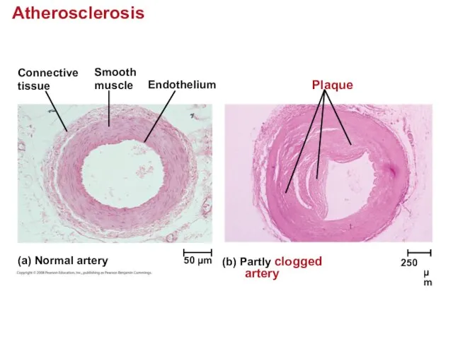 Atherosclerosis Connective tissue Smooth muscle Endothelium Plaque (a) Normal artery (b)