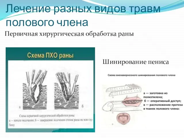 Лечение разных видов травм полового члена Первичная хирургическая обработка раны Шинирование пениса