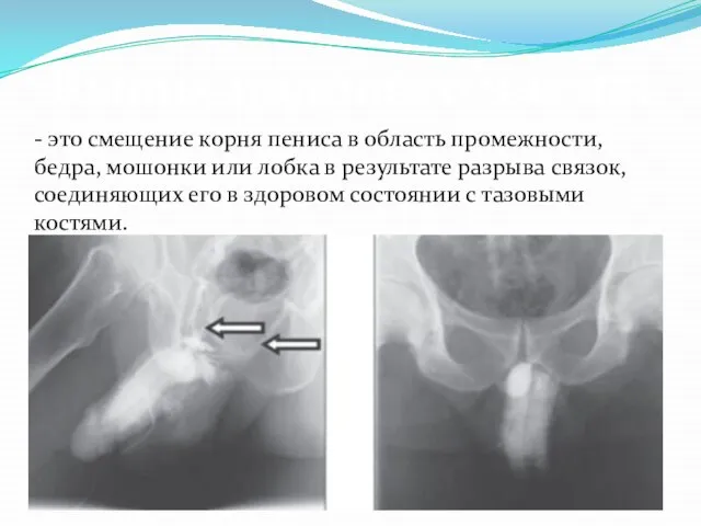 Вывих полового члена: - это смещение корня пениса в область промежности,