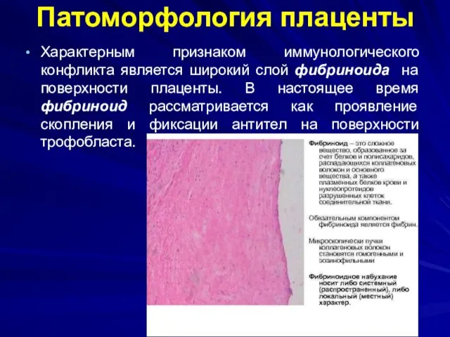 Патоморфология плаценты Характерным признаком иммунологического конфликта является широкий слой фибриноида на