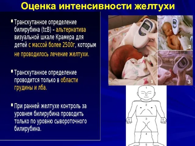 Оценка интенсивности желтухи