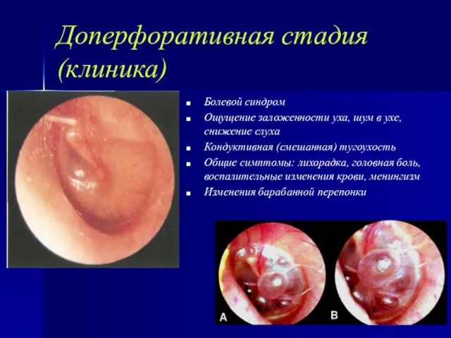 Доперфоративная стадия (клиника) Болевой синдром Ощущение заложенности уха, шум в ухе,