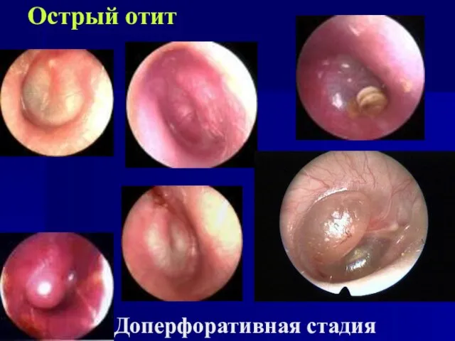 Острый отит Доперфоративная стадия