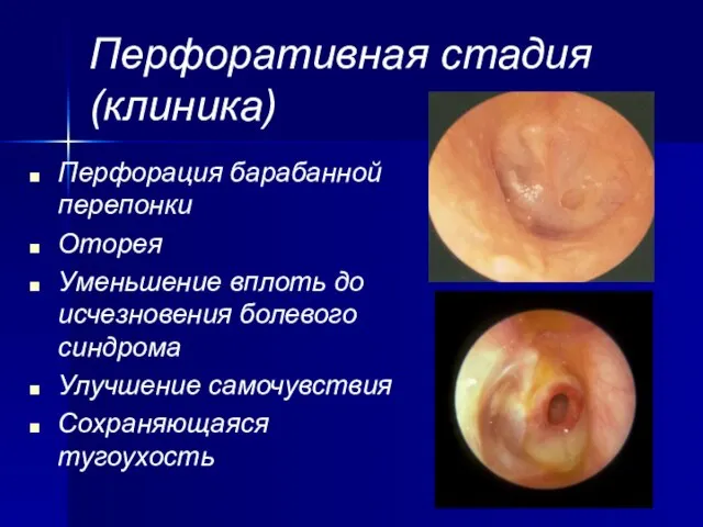 Перфоративная стадия (клиника) Перфорация барабанной перепонки Оторея Уменьшение вплоть до исчезновения