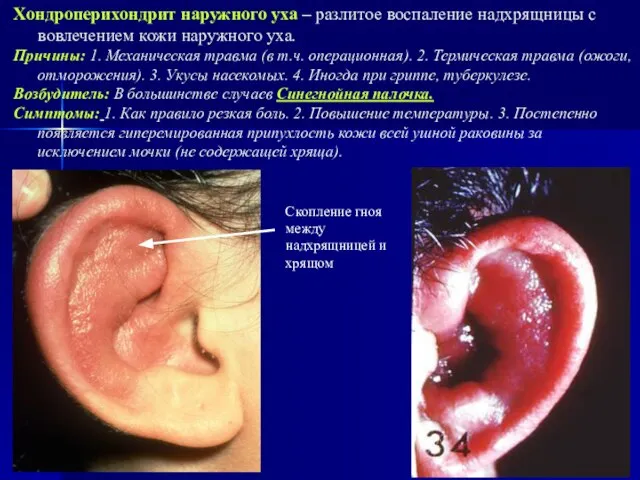 Хондроперихондрит наружного уха – разлитое воспаление надхрящницы с вовлечением кожи наружного