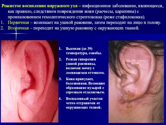 Рожистое воспаление наружного уха – инфекционное заболевание, являющееся, как правило, следствием