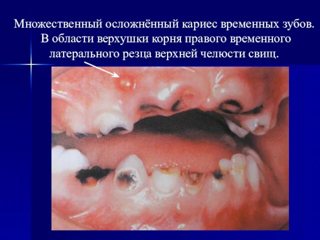 Множественный осложнённый кариес временных зубов. В области верхушки корня правого временного латерального резца верхней челюсти свищ.