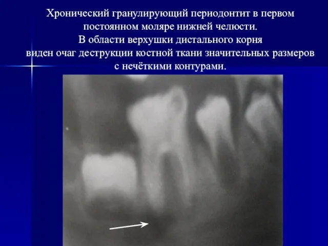 Хронический гранулирующий периодонтит в первом постоянном моляре нижней челюсти. В области