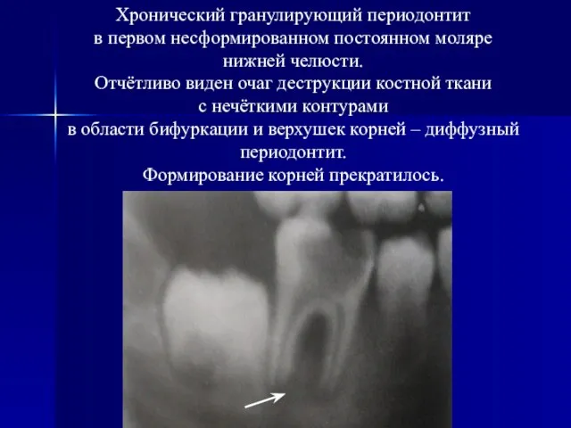 Хронический гранулирующий периодонтит в первом несформированном постоянном моляре нижней челюсти. Отчётливо