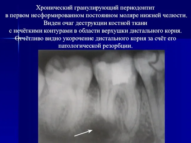 Хронический гранулирующий периодонтит в первом несформированном постоянном моляре нижней челюсти. Виден