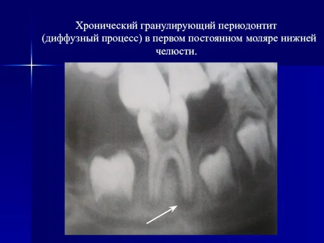 Хронический гранулирующий периодонтит (диффузный процесс) в первом постоянном моляре нижней челюсти.