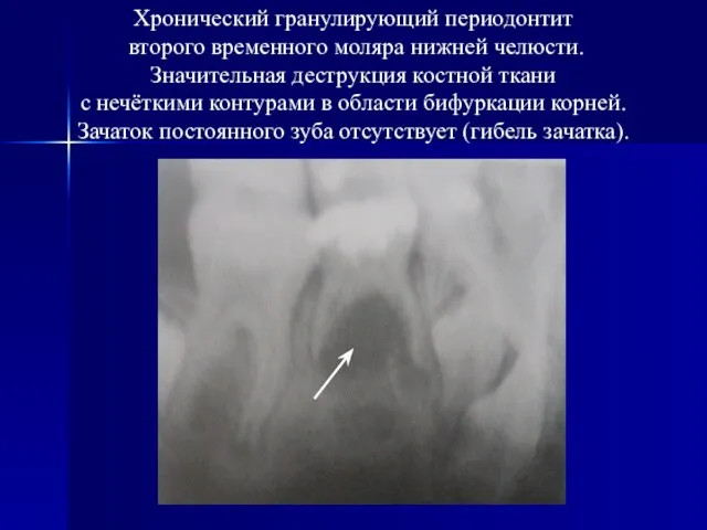 Хронический гранулирующий периодонтит второго временного моляра нижней челюсти. Значительная деструкция костной