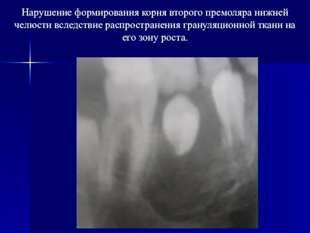 Нарушение формирования корня второго премоляра нижней челюсти вследствие распространения грануляционной ткани на его зону роста.