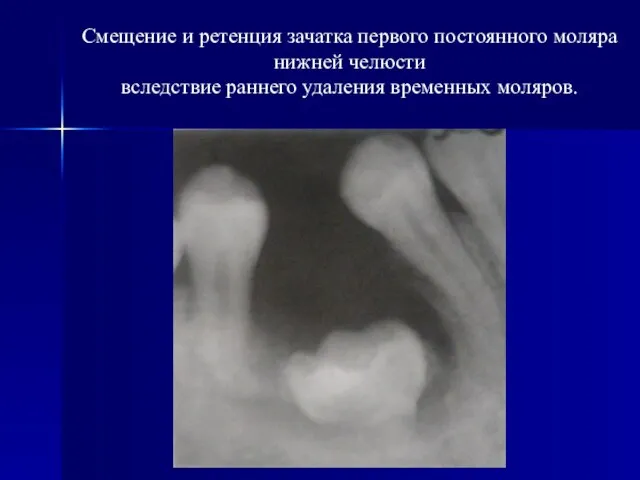 Смещение и ретенция зачатка первого постоянного моляра нижней челюсти вследствие раннего удаления временных моляров.