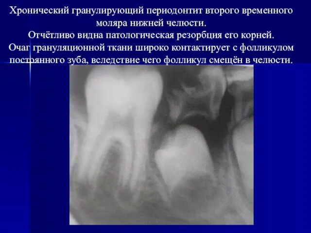 Хронический гранулирующий периодонтит второго временного моляра нижней челюсти. Отчётливо видна патологическая