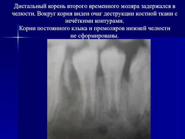 Дистальный корень второго временного моляра задержался в челюсти. Вокруг корня виден