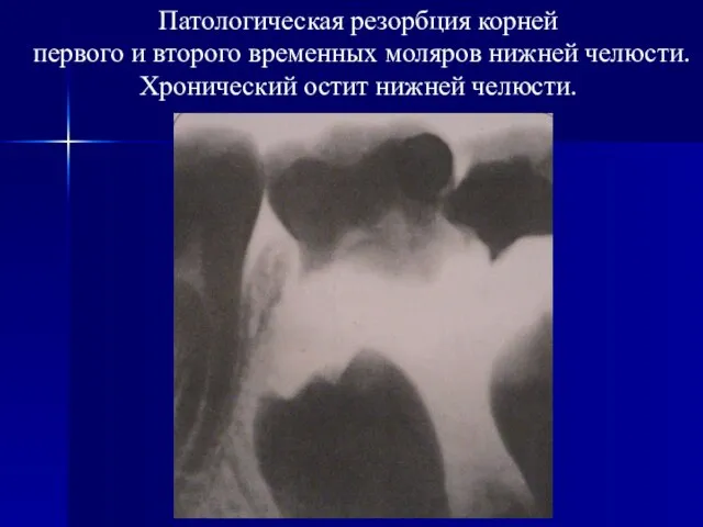 Патологическая резорбция корней первого и второго временных моляров нижней челюсти. Хронический остит нижней челюсти.